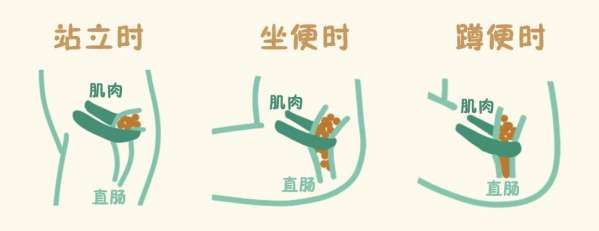 从科学角度来说，?便秘患者选择蹲便更优?。坐便虽然体位相对舒适，但会改变原本蹲位时的肛直角。肛直角是 ...